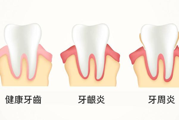 牙周炎能吃海鮮嗎？牙周炎如何自我判斷？