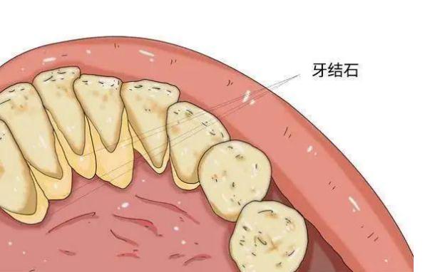 牙周炎可以用沖牙器嗎 ？牙周炎吃什么好？