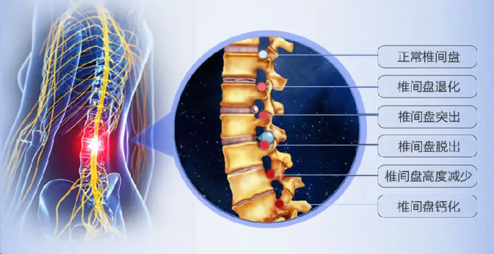 腰椎間盤突出久治不愈，快來(lái)試試仙濟(jì)玉靈貼！