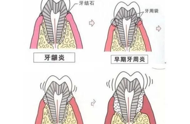 牙周炎會癌變嗎？牙周炎會病變嗎？