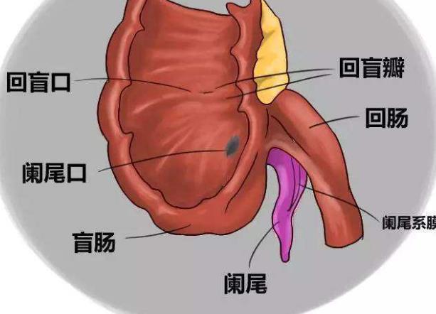 急性闌尾炎痛嗎 闌尾炎疼嗎