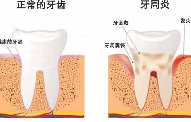 牙周炎檢查？牙周炎小偏方？