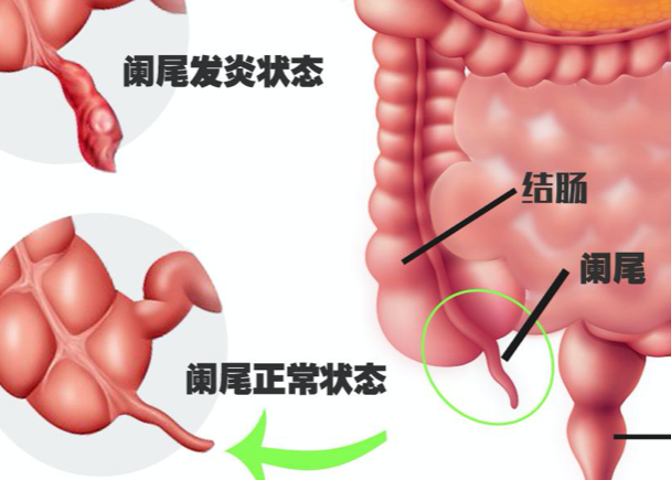 慢性闌尾炎會引起腰疼嗎 右下腹經(jīng)常性疼痛