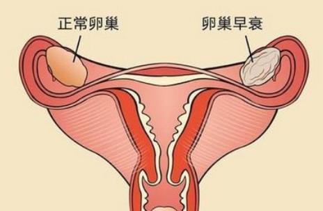 卵巢早衰有哪些癥狀表現(xiàn) 性欲低下是卵巢早衰嗎