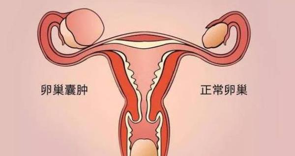 卵巢囊腫大小多少算正常 如何預(yù)防卵巢囊腫