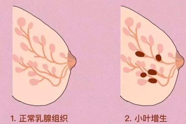 內(nèi)分泌絮亂會導致乳腺增生嗎 乳腺增生腋窩里會疼嗎