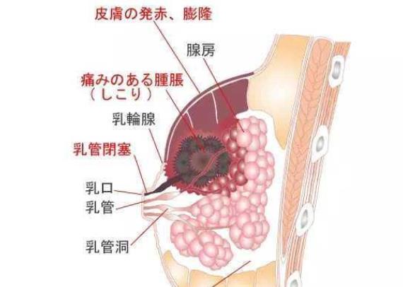 乳腺炎患者能運動嗎 如何才能根治乳腺炎