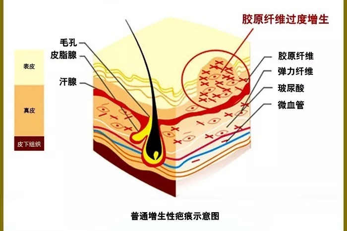 【沈陽膚康疤痕科普】之紋身疤痕，紋身雖美，疤痕防治不可忽視