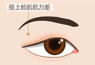 合肥愛爾眼科醫(yī)院：上瞼下垂＝眼皮松弛？其實(shí)真相是……