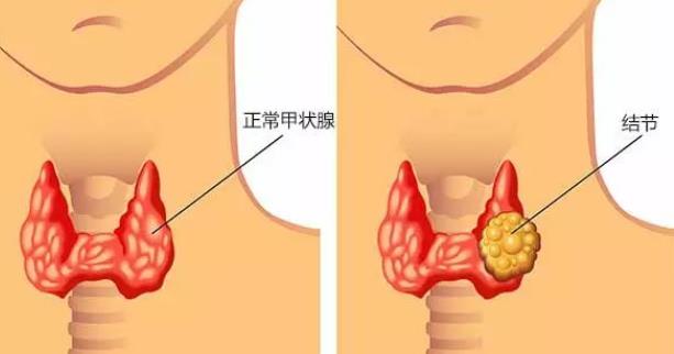 玻璃結(jié)節(jié)肺部是癌癥嗎 結(jié)節(jié)距離癌癥有多遠(yuǎn)