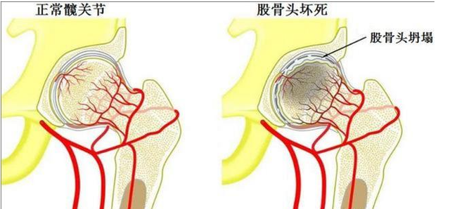 慎用激素藥！激素導(dǎo)致股骨頭壞死不要怕，通血生骨方純中藥調(diào)理，從根源治療！