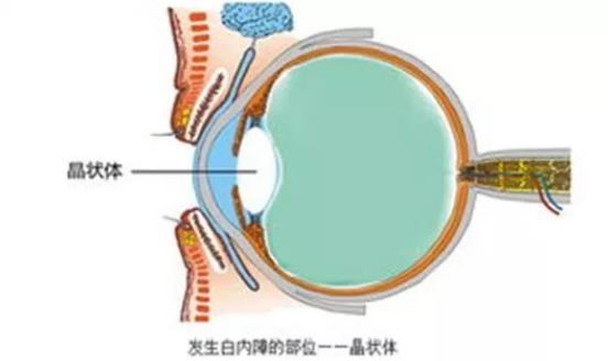 白內障術后眼壓高怎么辦 白內障術后眼壓高多久恢復