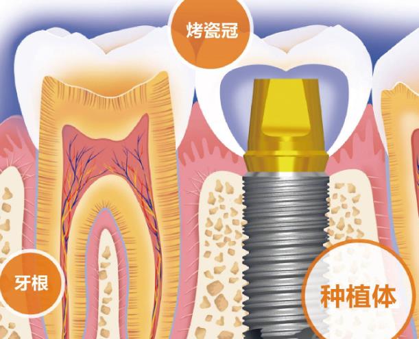 種植牙戴牙冠疼嗎 種植牙多久可以裝牙冠