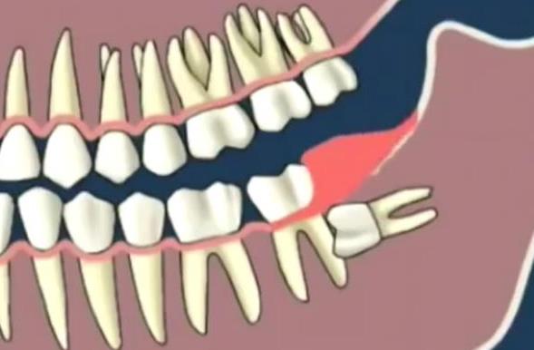 怎么判斷智齒有沒(méi)有長(zhǎng)歪 智齒疼怎么辦