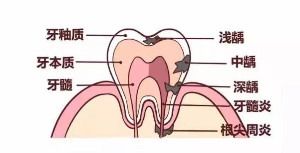 慢性牙髓炎能吃藥治好嗎 牙髓炎根尖炎怎么治療