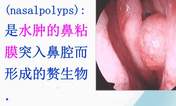 鼻息肉流鼻血是怎么回事 鼻息肉流鼻血怎么辦