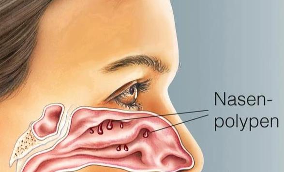 鼻息肉會痛嗎 鼻息肉手術(shù)會痛嗎