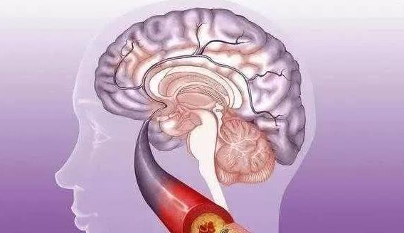 腦梗后遺癥怎么康復(fù) 腦梗的病因是什么