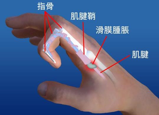 長時間玩手機容易得腱鞘炎嗎 腱鞘炎都有哪些癥狀