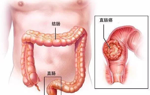 直腸癌晚期最怕哪些情況 直腸癌能治好嗎