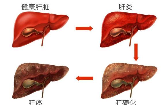 肝硬化患者要做胃鏡嗎 如何預防和逆轉肝硬化