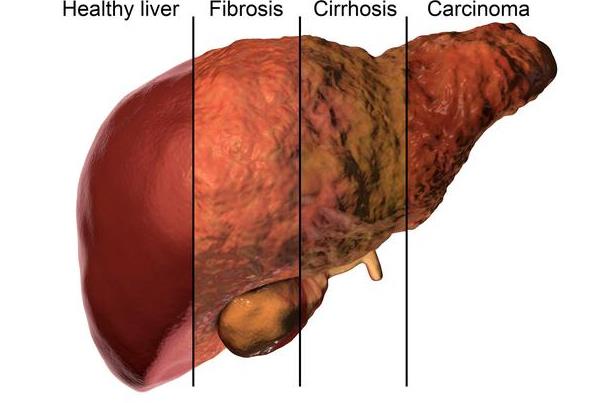 肝硬化可以吃豆腐腦嗎 肝硬化患者能吃雞蛋嗎