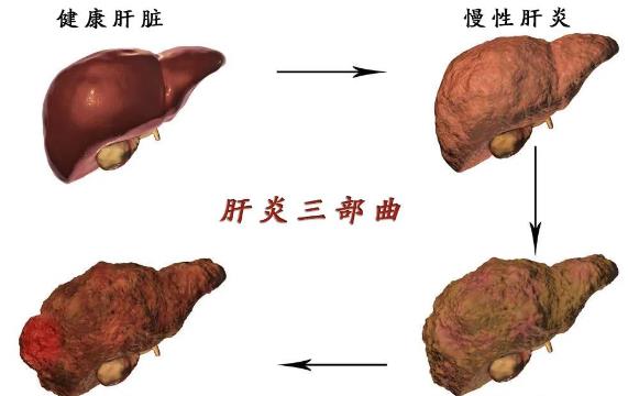 肝硬化病人胃脹怎么回事 肝硬化晚期有哪些并發(fā)癥