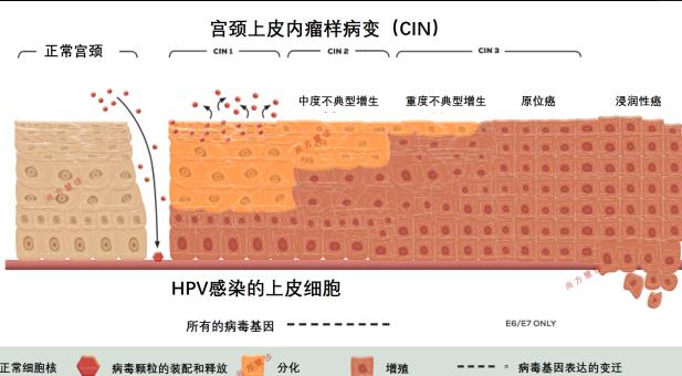 宮頸癌是否可以治愈 hpv51型陽性怎么辦