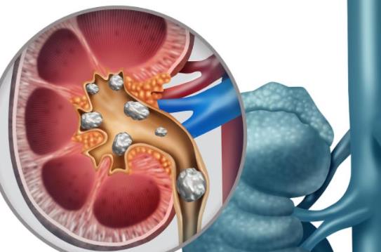 腎結(jié)石多大需要手術(shù) 腎結(jié)石會(huì)變成腎炎嗎