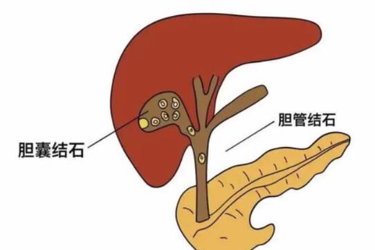 膽結石可以吃柿子嗎 膽結石能吃豆類嗎