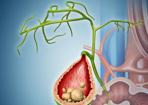 膽結(jié)石手術(shù)有風險嗎 膽結(jié)石手術(shù)有哪些風險