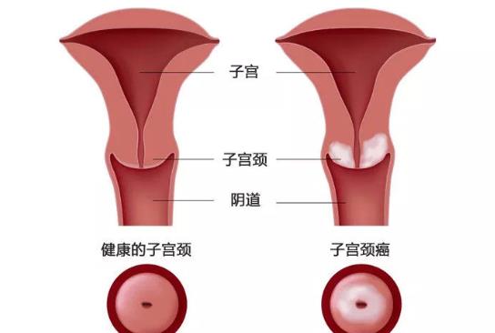 宮頸炎會(huì)不會(huì)影響月經(jīng) 輕微宮頸炎會(huì)出血嗎