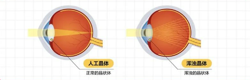 遇到這些眼睛問(wèn)題要重視！合肥愛(ài)爾專(zhuān)家分享—父母眼健康小知識(shí)