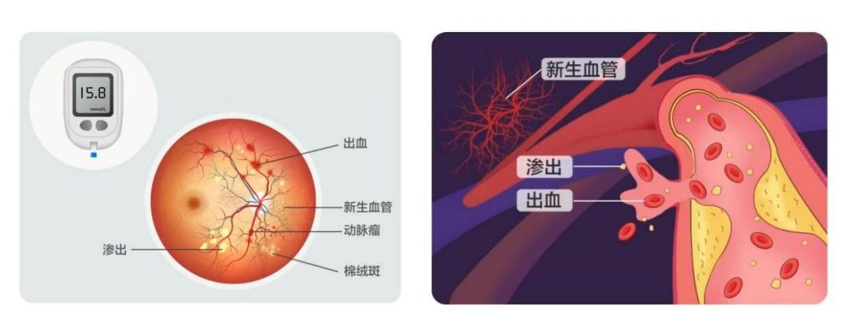 【合肥愛爾】得了糖尿病，為什么醫(yī)生讓我看眼科？