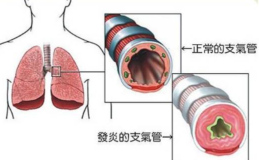 慢性支氣管炎嚴(yán)重嗎 支氣管炎嚴(yán)重嗎