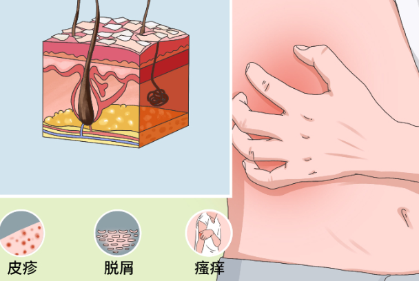 銀屑病會自愈嗎 尋常型銀屑病會自愈嗎