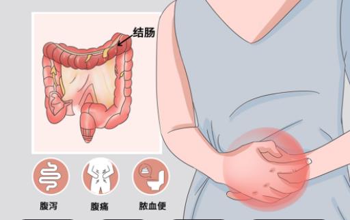 結(jié)腸炎吃乳酸菌素片好嗎 結(jié)腸炎做什么檢查