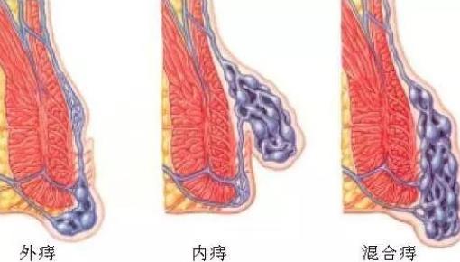 有痔瘡可以當兵嗎 十男九痔是真的嗎