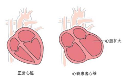 感冒會誘發(fā)心衰嗎 冠心病會誘發(fā)心衰嗎